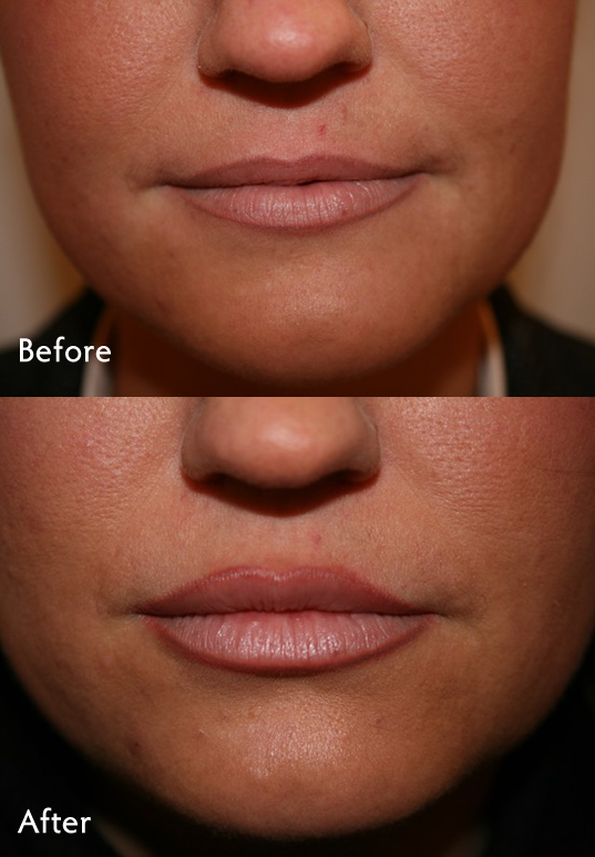 Dermal fillers - before and after